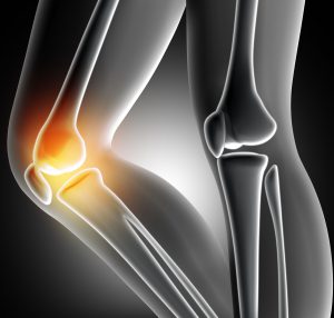 3D render of a female medical legs with bones in knee highlighted